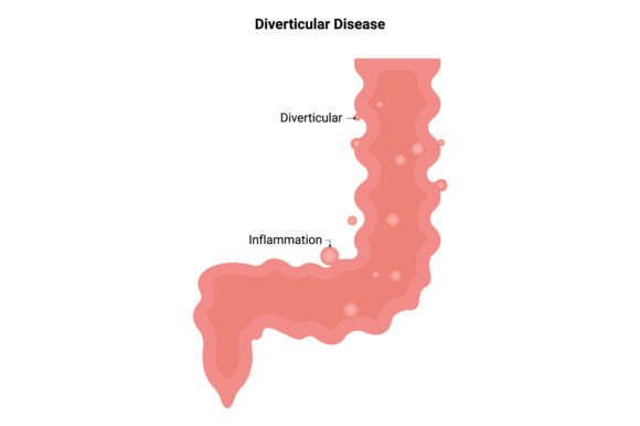 Download Diverticular Disease Science Design - Science Collection