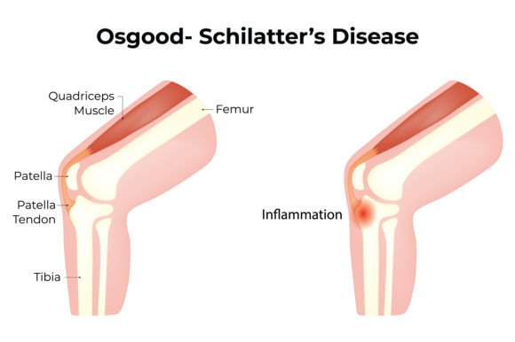 Download Osgood Schilatters Disease Science - Science Collection