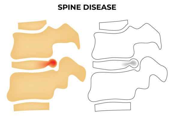 Download Spine Disease Science Design Vector - Science Collection