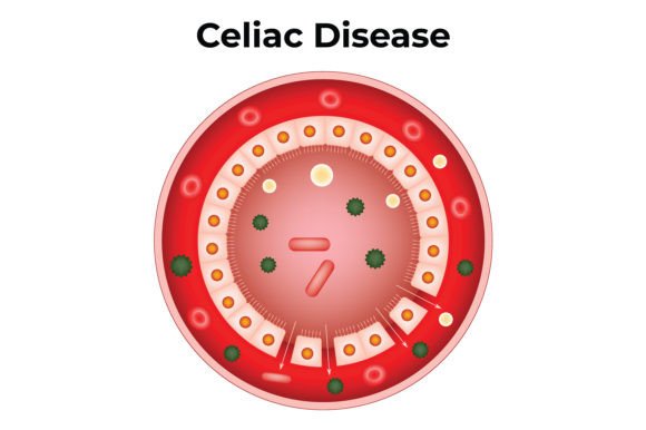Download Celiac Disease Science Design Vector - Science Collection