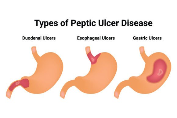 Download Type of Peptic Ulcer Disease Science Des - Science Collection