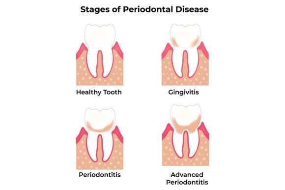 Download Stages of Periodontal Disease Science - Science Collection